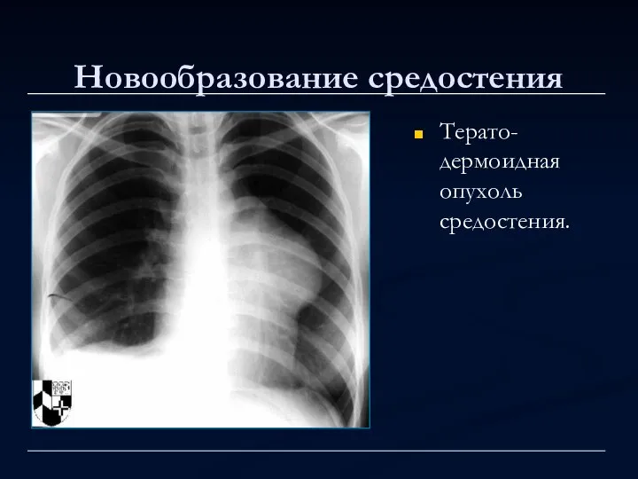 Новообразование средостения Терато-дермоидная опухоль средостения.