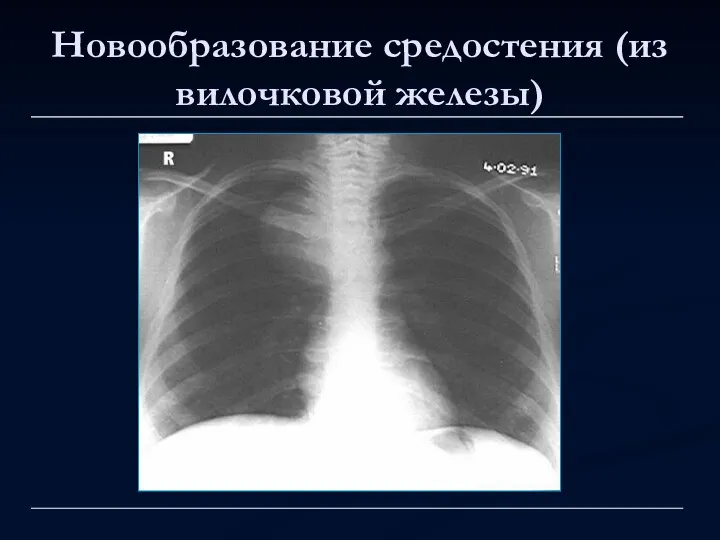 Новообразование средостения (из вилочковой железы)