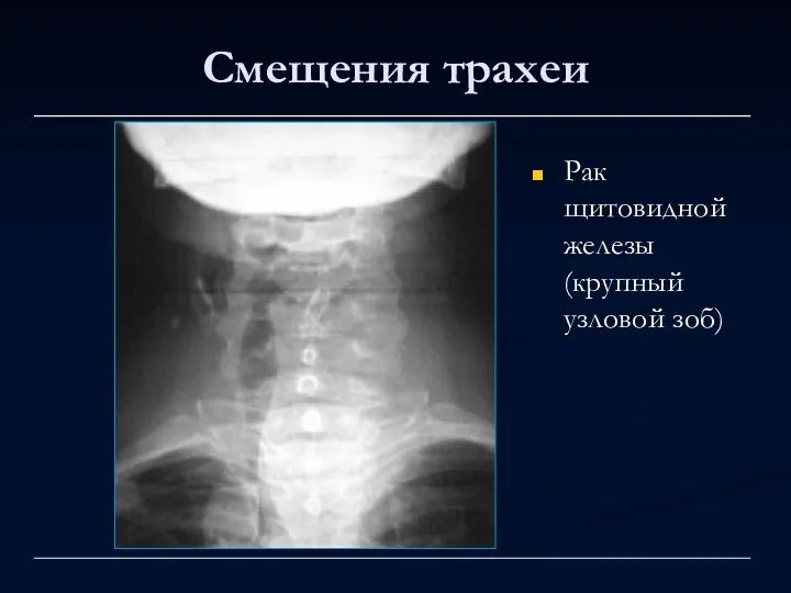 Смещения трахеи Рак щитовидной железы (крупный узловой зоб)