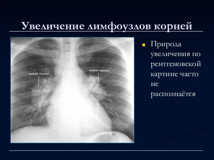 Увеличение лимфоузлов корней Природа увеличения по рентгеновской картине часто не распознаётся