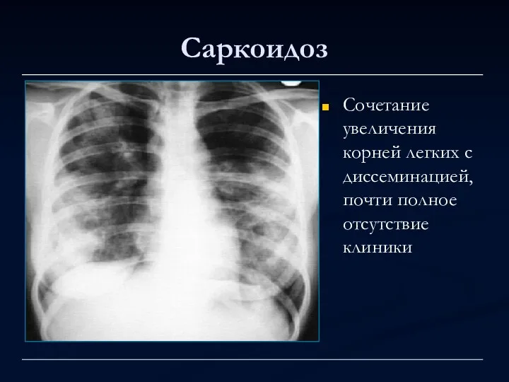 Саркоидоз Сочетание увеличения корней легких с диссеминацией, почти полное отсутствие клиники