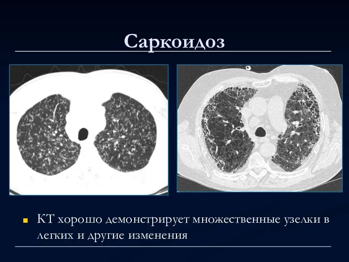 Саркоидоз КТ хорошо демонстрирует множественные узелки в легких и другие изменения