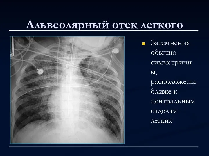 Альвеолярный отек легкого Затемнения обычно симметричны, расположены ближе к центральным отделам легких