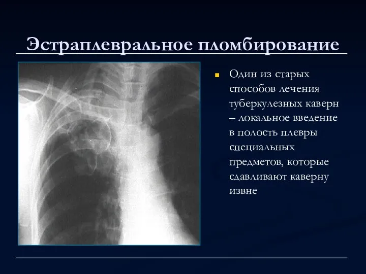 Эстраплевральное пломбирование Один из старых способов лечения туберкулезных каверн – локальное введение