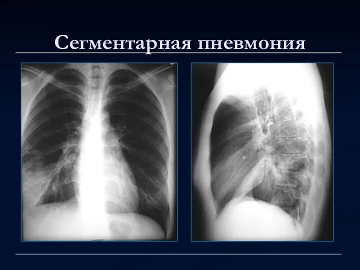 Сегментарная пневмония