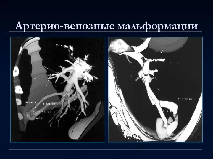 Артерио-венозные мальформации