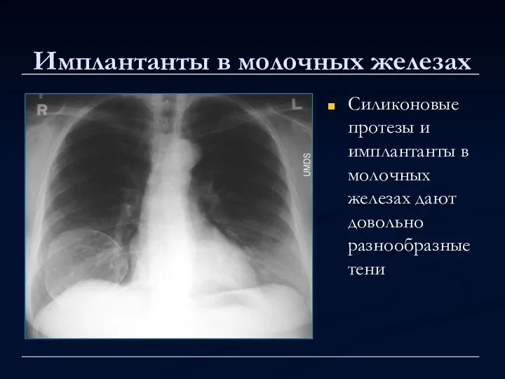 Имплантанты в молочных железах Силиконовые протезы и имплантанты в молочных железах дают довольно разнообразные тени