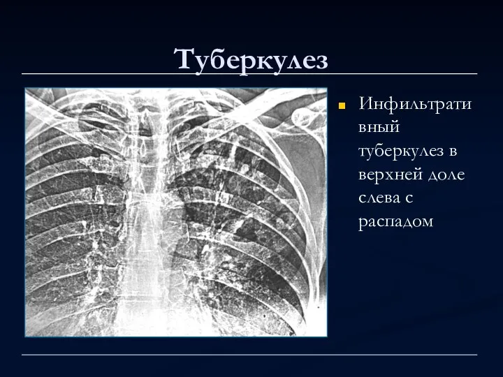 Туберкулез Инфильтративный туберкулез в верхней доле слева с распадом