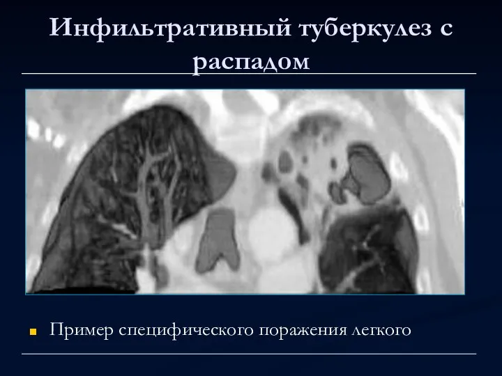 Инфильтративный туберкулез с распадом Пример специфического поражения легкого