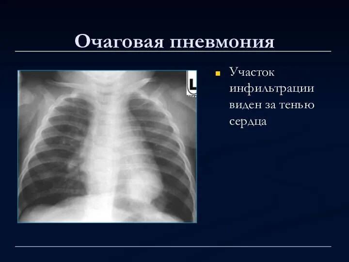 Очаговая пневмония Участок инфильтрации виден за тенью сердца