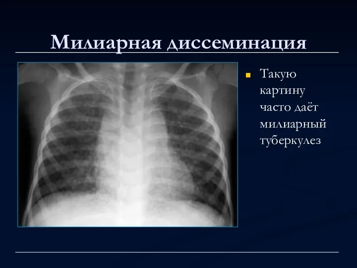 Милиарная диссеминация Такую картину часто даёт милиарный туберкулез