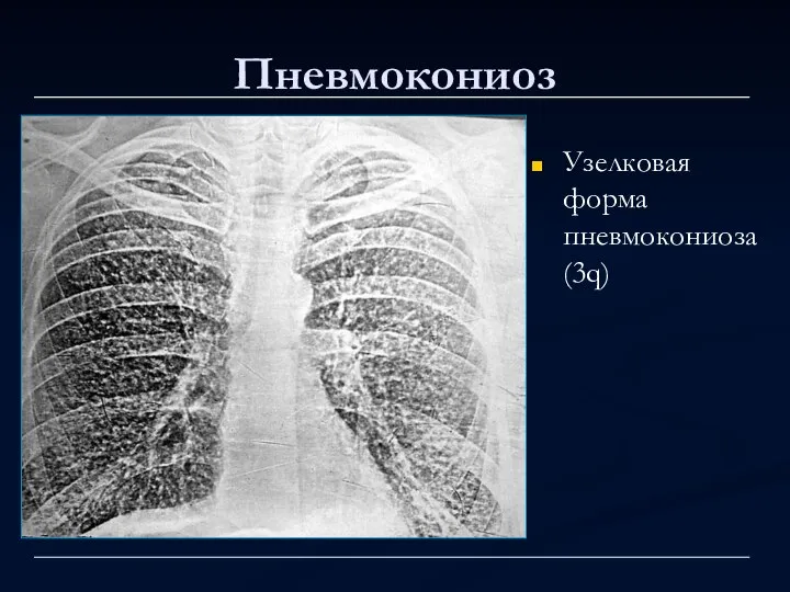 Пневмокониоз Узелковая форма пневмокониоза (3q)