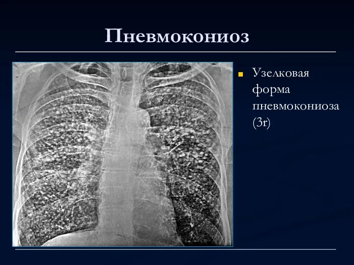 Пневмокониоз Узелковая форма пневмокониоза (3r)