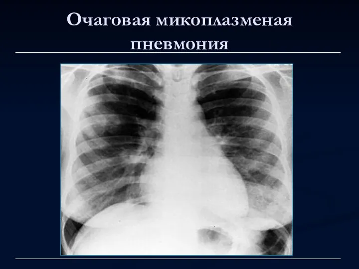 Очаговая микоплазменая пневмония