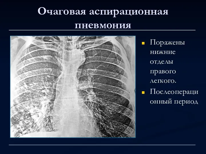 Очаговая аспирационная пневмония Поражены нижние отделы правого легкого. Послеоперационный период