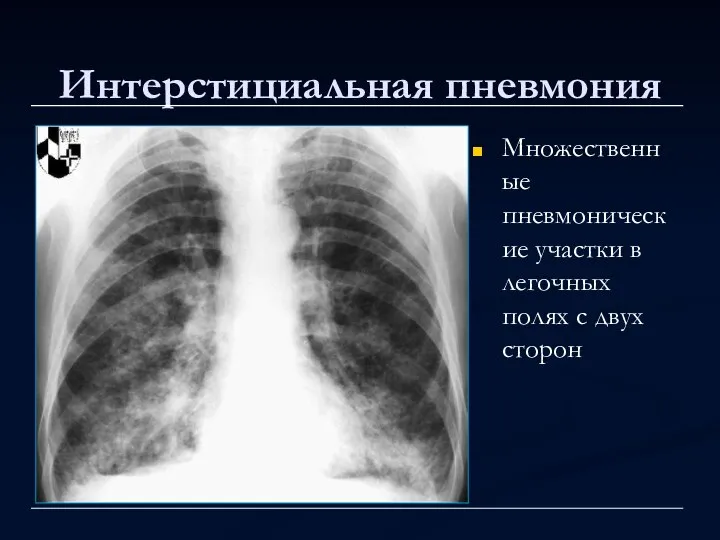 Интерстициальная пневмония Множественные пневмонические участки в легочных полях с двух сторон
