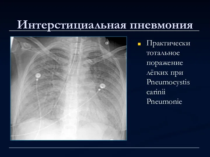 Интерстициальная пневмония Практически тотальное поражение лёгких при Pneumocystis carinii Pneumonie
