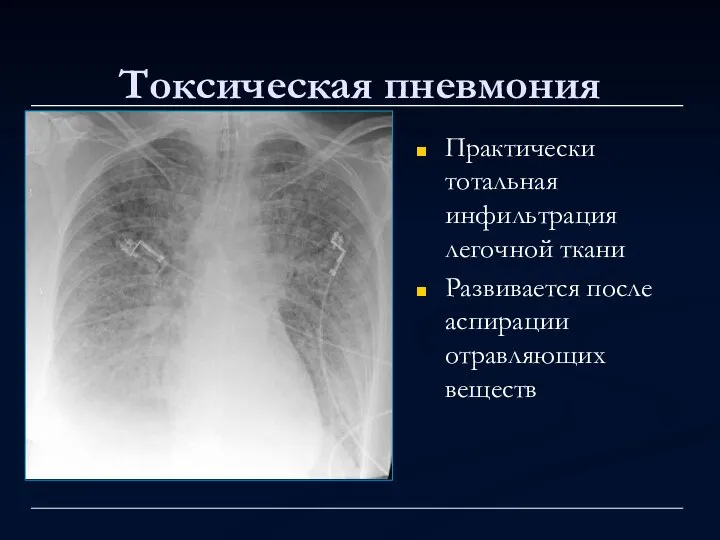 Токсическая пневмония Практически тотальная инфильтрация легочной ткани Развивается после аспирации отравляющих веществ