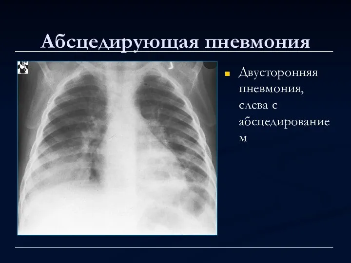Абсцедирующая пневмония Двусторонняя пневмония, слева с абсцедированием