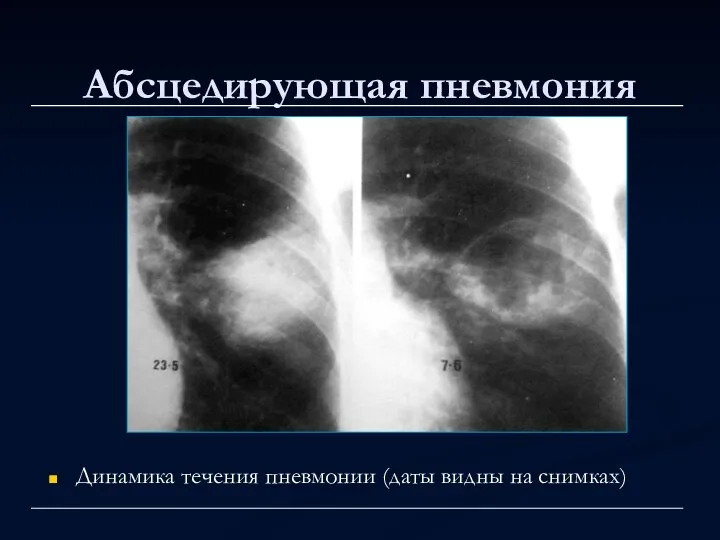 Абсцедирующая пневмония Динамика течения пневмонии (даты видны на снимках)