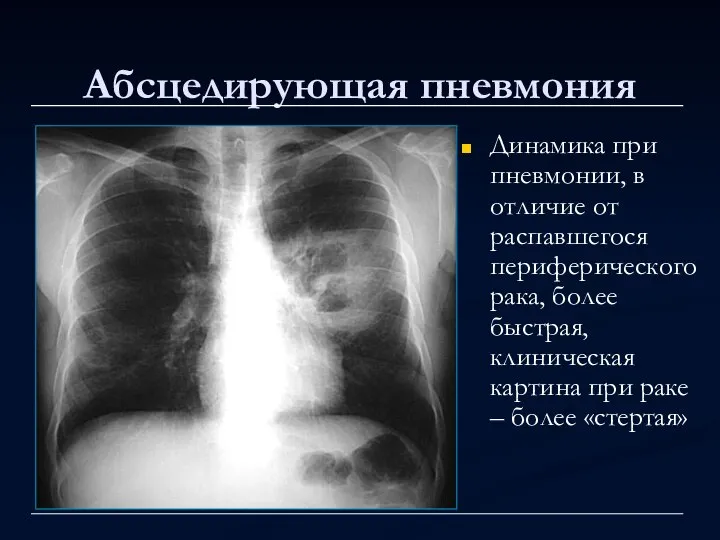 Абсцедирующая пневмония Динамика при пневмонии, в отличие от распавшегося периферического рака, более