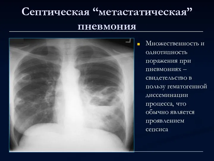 Септическая “метастатическая” пневмония Множественность и однотипность поражения при пневмониях – свидетельство в