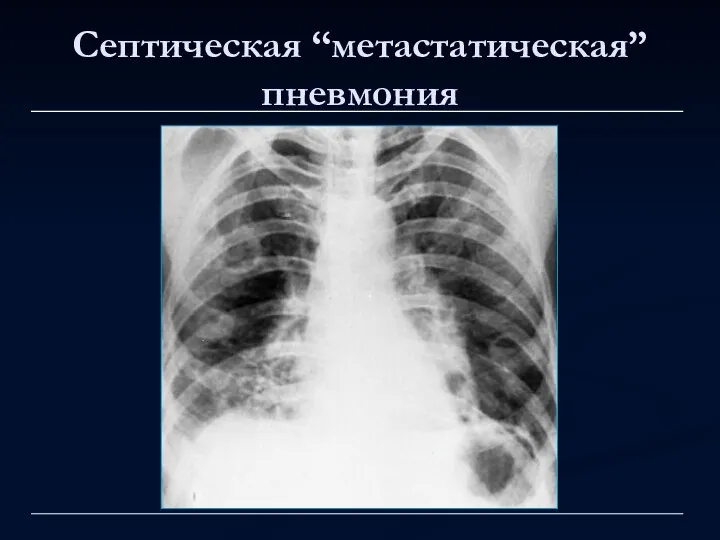 Септическая “метастатическая” пневмония