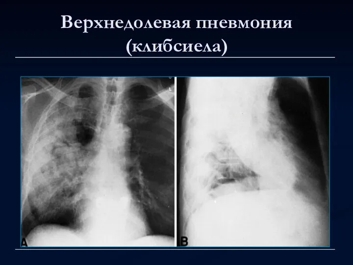 Верхнедолевая пневмония (клибсиела)