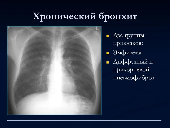 Хронический бронхит Две группы признаков: Эмфизема Диффузный и прикорневой пневмофиброз