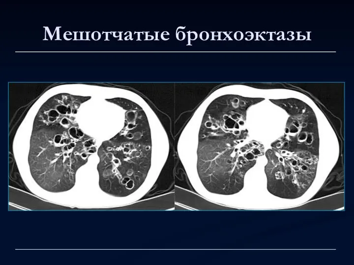 Мешотчатые бронхоэктазы