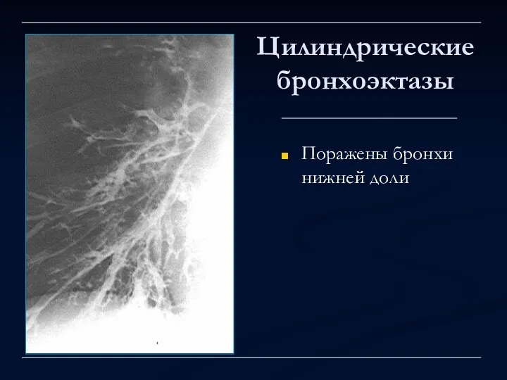 Цилиндрические бронхоэктазы Поражены бронхи нижней доли