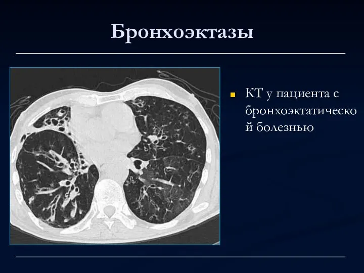 Бронхоэктазы КТ у пациента с бронхоэктатической болезнью