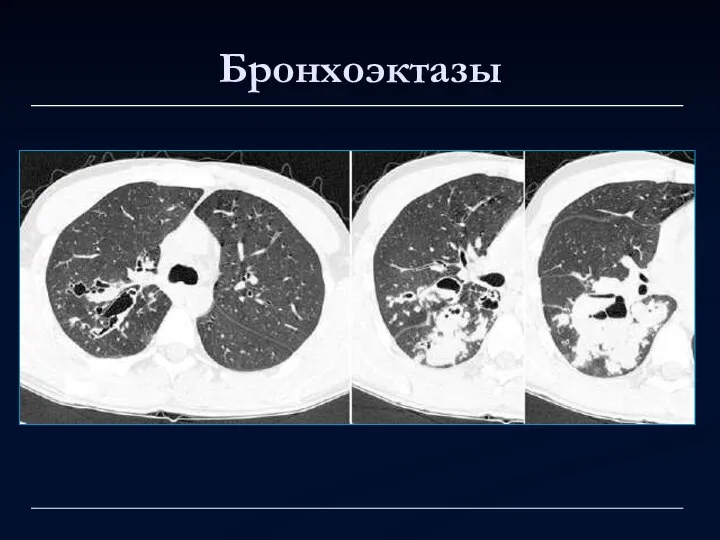 Бронхоэктазы