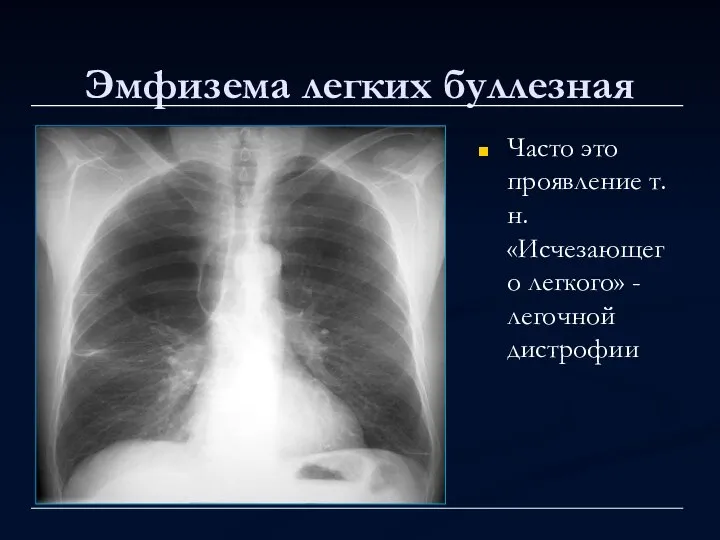 Эмфизема легких буллезная Часто это проявление т.н. «Исчезающего легкого» - легочной дистрофии