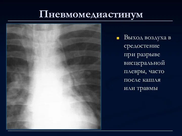 Пневмомедиастинум Выход воздуха в средостение при разрыве висцеральной плевры, часто после кашля или травмы