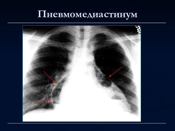 Пневмомедиастинум