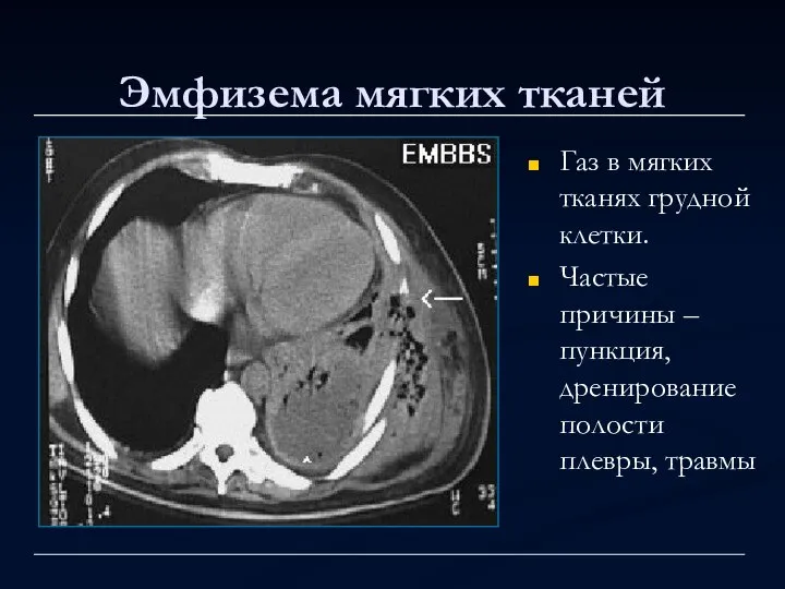 Эмфизема мягких тканей Газ в мягких тканях грудной клетки. Частые причины –