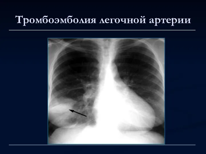 Тромбоэмболия легочной артерии