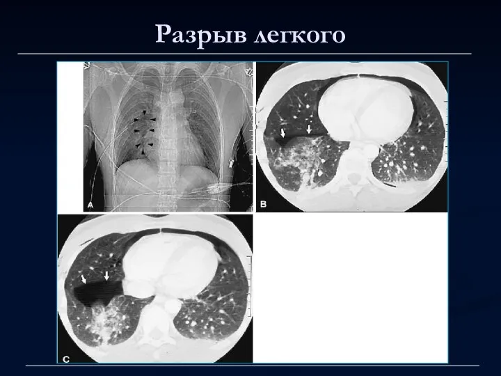 Разрыв легкого