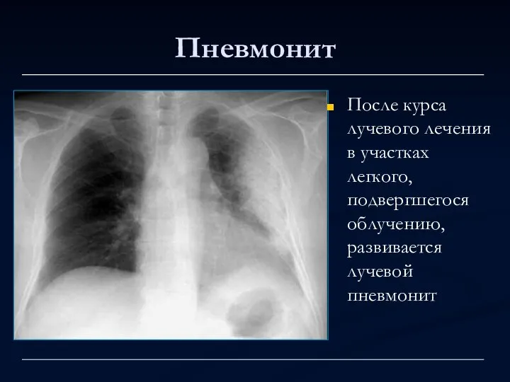 Пневмонит После курса лучевого лечения в участках легкого, подвергшегося облучению, развивается лучевой пневмонит