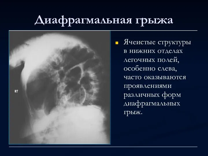 Диафрагмальная грыжа Ячеистые структуры в нижних отделах легочных полей, особенно слева, часто