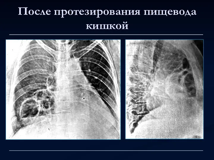 После протезирования пищевода кишкой