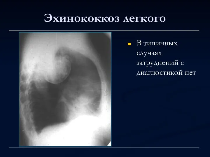 Эхинококкоз легкого В типичных случаях затруднений с диагностикой нет