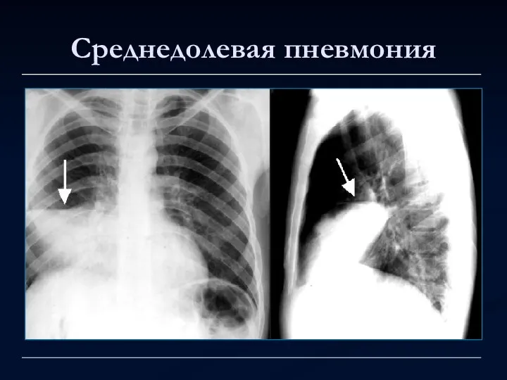 Среднедолевая пневмония