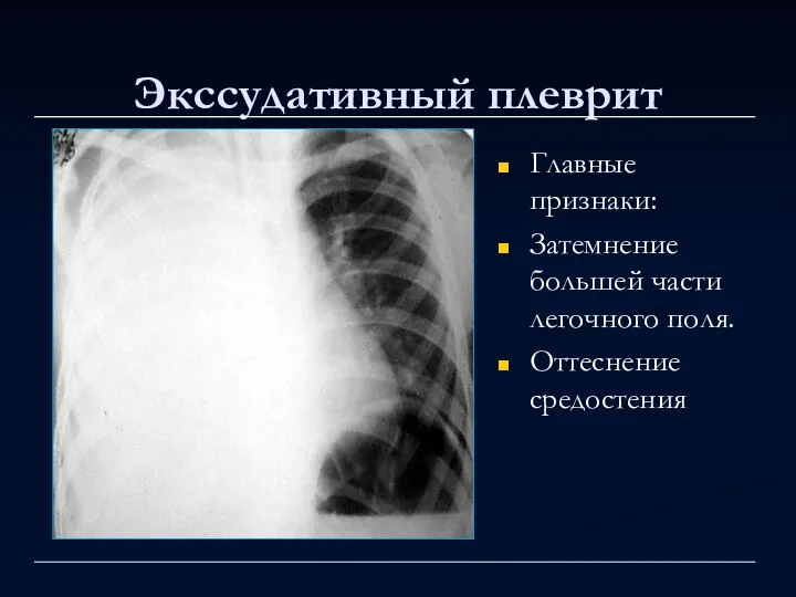 Экссудативный плеврит Главные признаки: Затемнение большей части легочного поля. Оттеснение средостения