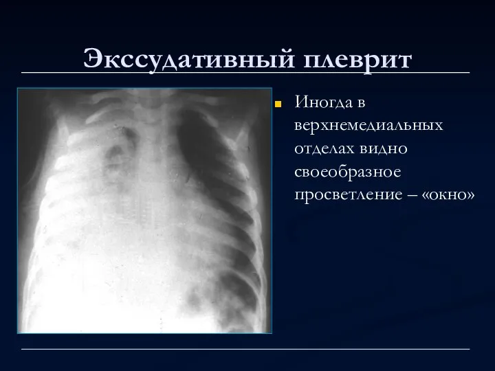 Экссудативный плеврит Иногда в верхнемедиальных отделах видно своеобразное просветление – «окно»