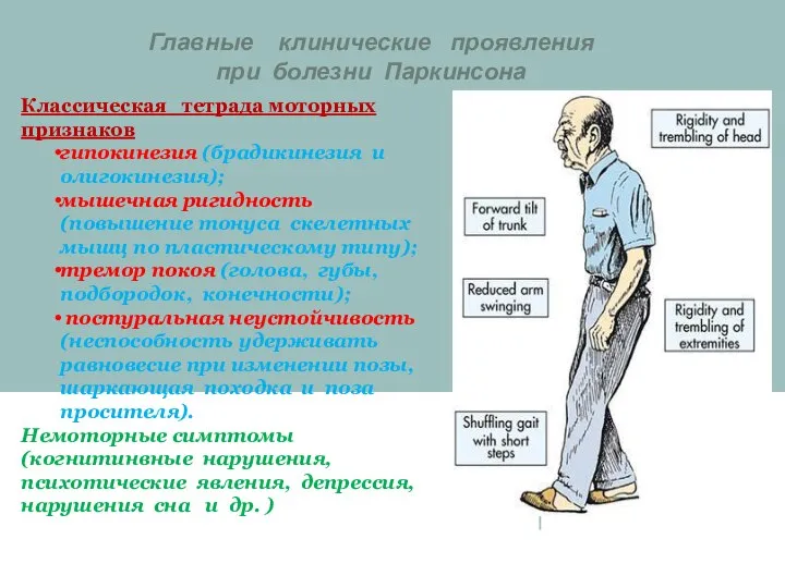 Главные клинические проявления при болезни Паркинсона Классическая тетрада моторных признаков гипокинезия (брадикинезия