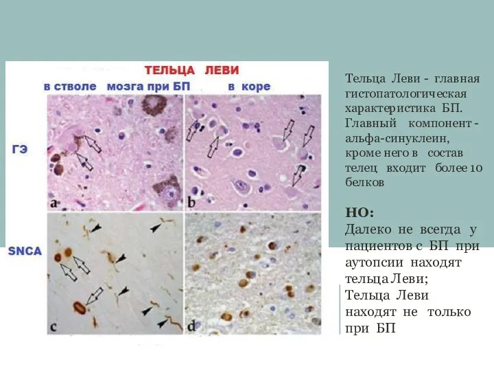 Тельца Леви - главная гистопатологическая характеристика БП. Главный компонент - альфа-синуклеин, кроме