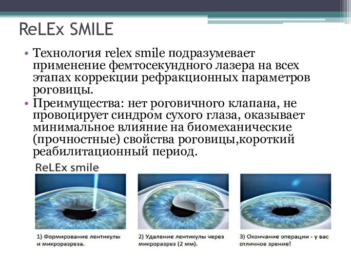 ReLEx SMILE Технология relex smile подразумевает применение фемтосекундного лазера на всех этапах