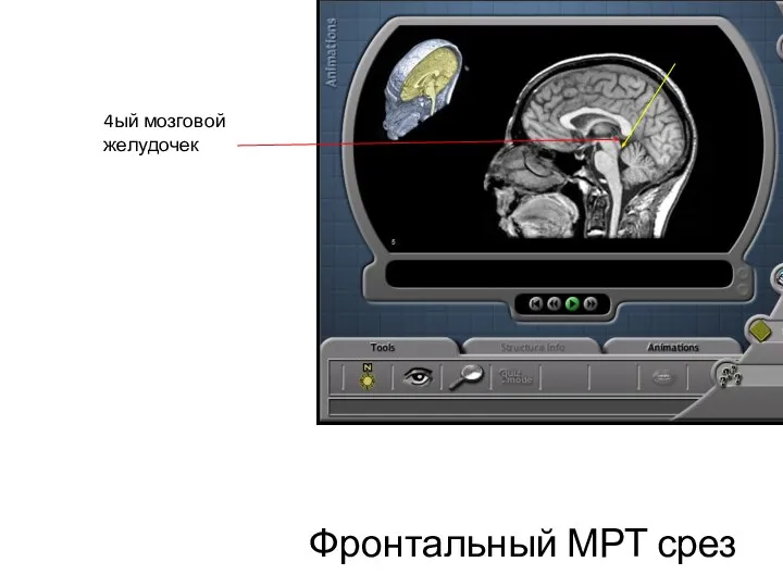 Фронтальный МРТ срез 4ый мозговой желудочек